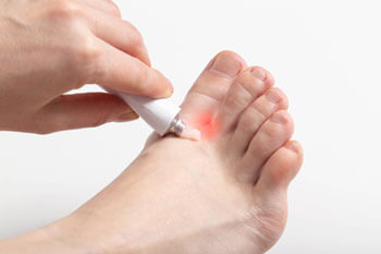 Athletes foot treatment in the St. Charles, MO 63303 areas
