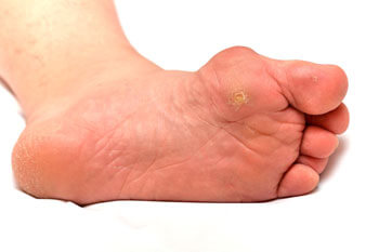 corns treatment in the St. Charles, MO 63303 areas