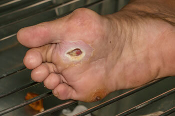Diabetic foot treatment and care, Diabetic Ulcers Treatment & Management in the St. Charles, MO 63303 areas