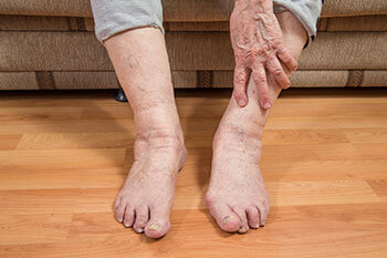 Geriatric foot care treatment in the St. Charles, MO 63303 areas