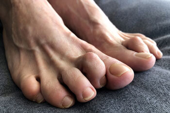 Hammertoes & Mallet Toes treatment in St. Charles, MO 63303 areas