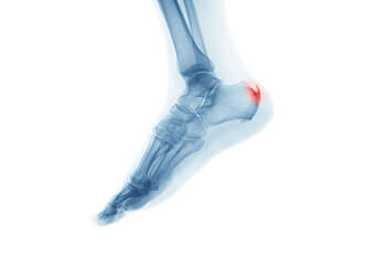 Heel spurs treatment in the St. Charles, MO 63303 areas