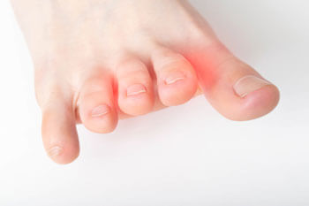Mortons neuroma treatment in the St. Charles, MO 63303 areas