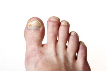 Fungal toenails, toenail fungus diagnosis and treatment in the St. Charles, MO 63303 areas