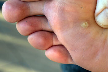Plantar warts treatment in St. Charles, MO 63303 areas