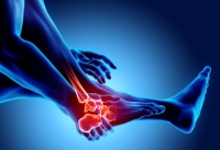 What Is a Foot Stress Fracture?